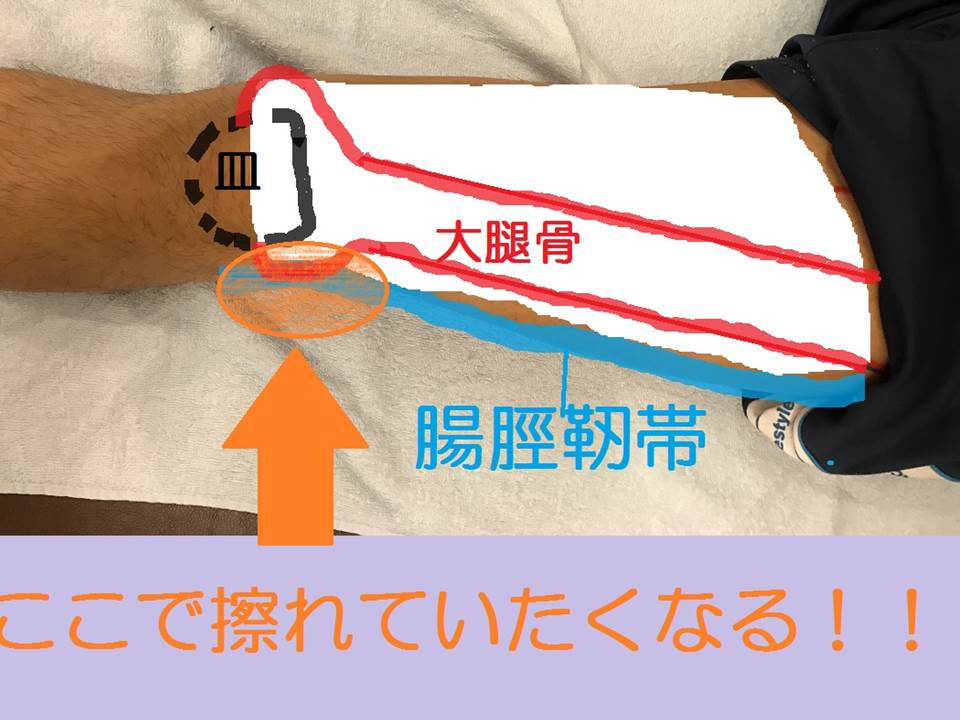 腸脛靭帯ここで痛くなる
