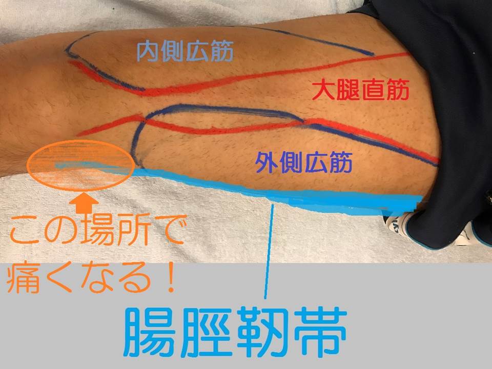 腸脛靭帯ここで痛くなる