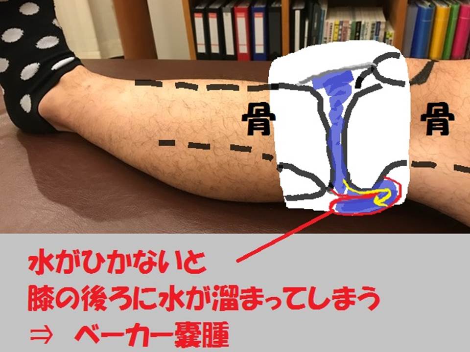 ベーカー嚢腫