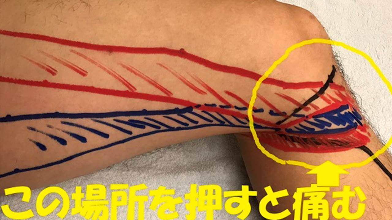 「鵞足炎」かも！？ランニングすると膝の内側が痛みます！ 柔 YAWARA｜岡崎市の肩こり・腰痛・膝痛専門整体